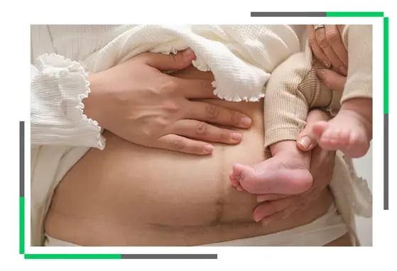 Cesarskie cięcie, a mikrobiota noworodka Brzuch kobiety po porodzie z widoczną kresą ciemną, trzymającej niemowlę